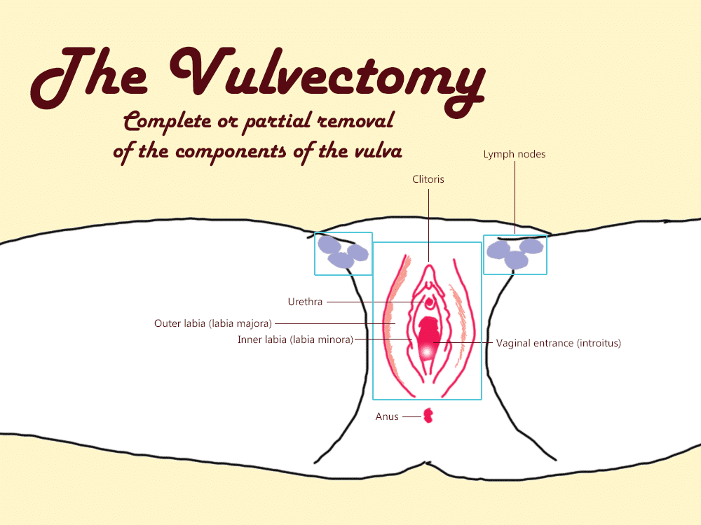 Vulvectomy