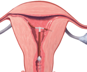 IUD and BV