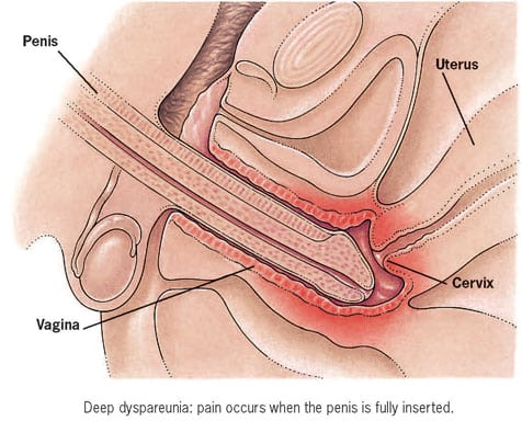 Dyspareunia 