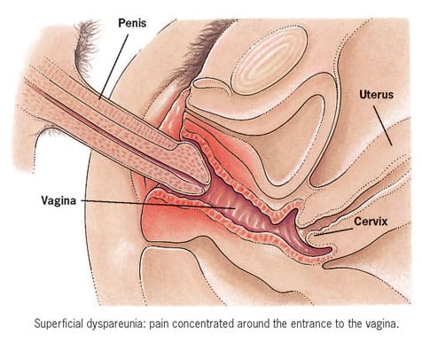 Dyspareunia 