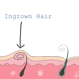 Discover more than 143 ingrown hair bump on groin super hot