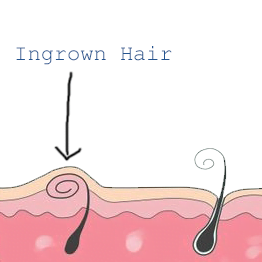 Ingrown hairs  NHS