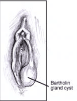 Bartholin Gland Cysts