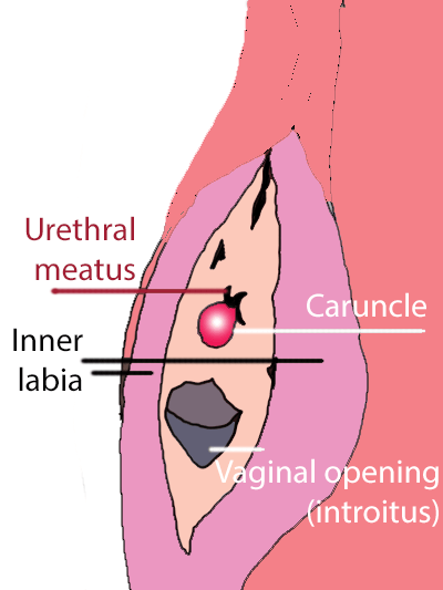 Urethral Caruncle