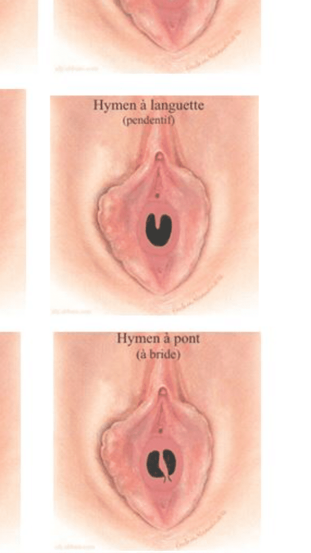 Vaginal septa