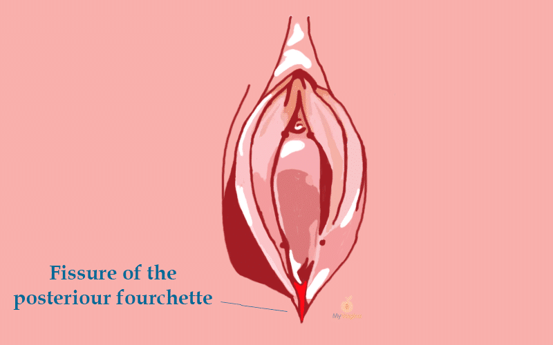 Posterior fourchette - My Vagina