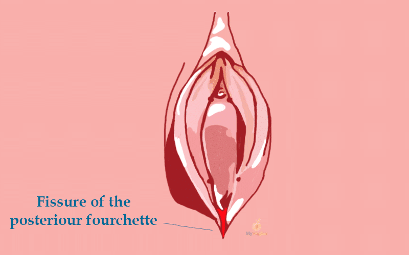 How to Stop Posterior Fourchette Tears  