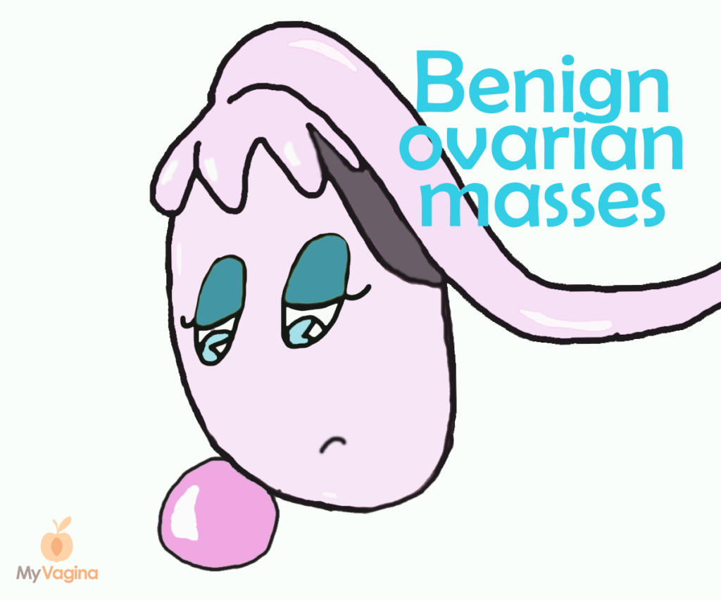 Benign ovarian masses - My Vagina