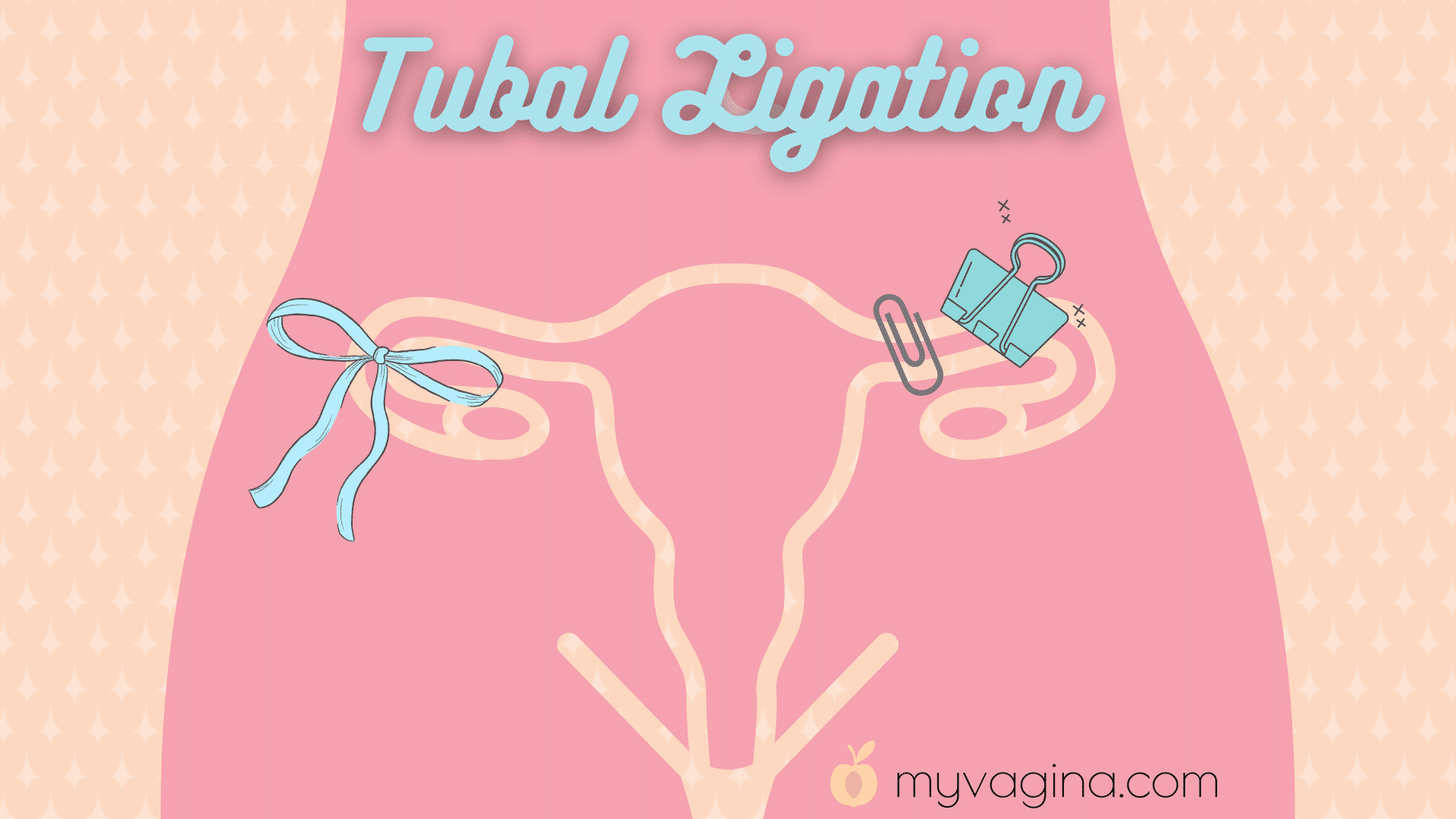 What is tubal ligation? - Advantages and consequences