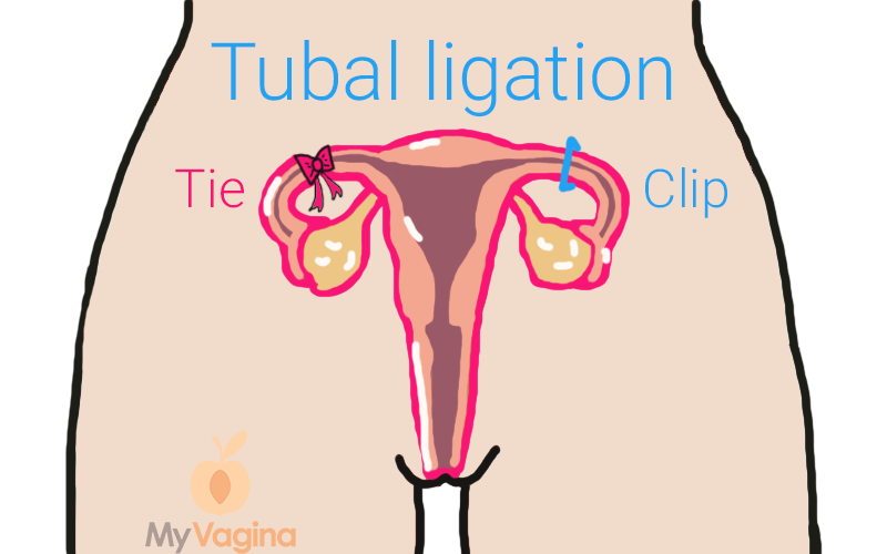 What Getting Your Tubes Tied Really Means Besides Freedom My Vagina