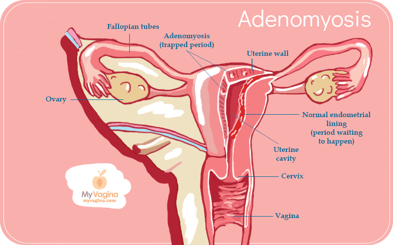 Reproductive Tract Adenomyosis