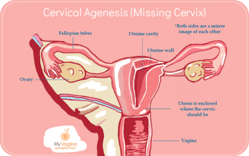 Reproductive Tract Cervical Agenesis