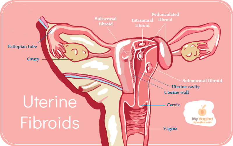 Uterine Fibroids