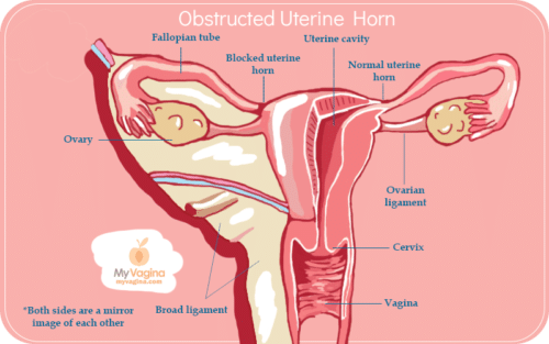 Obstructed Uterine Horn