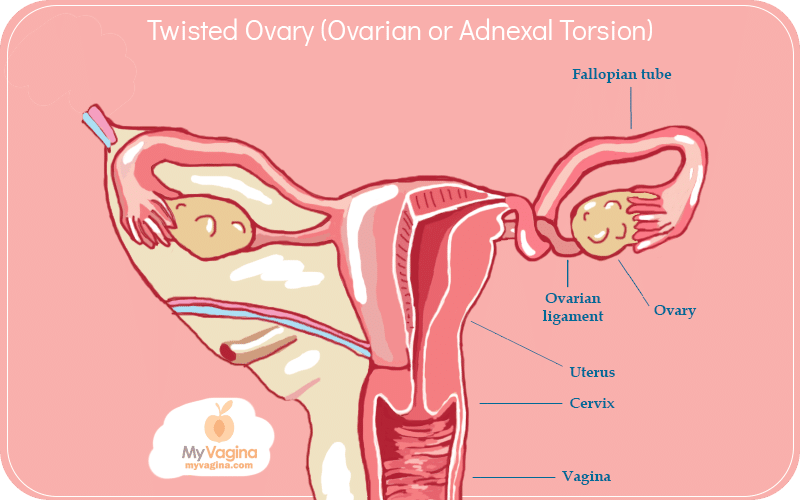 Twisted Ovary