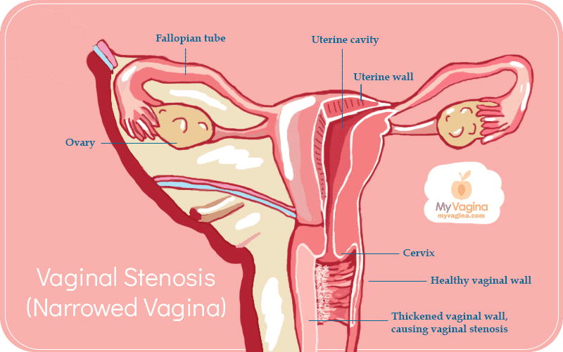 Reproductive Tract Vaginal Stenosis REAL VERSION