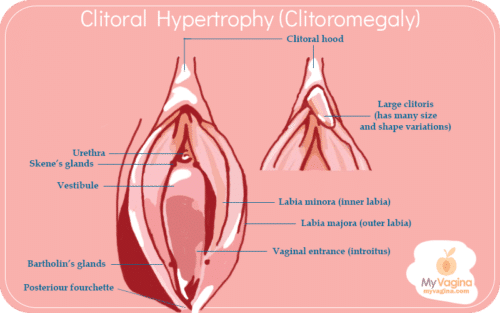 Large Clitoris Clitoromegaly