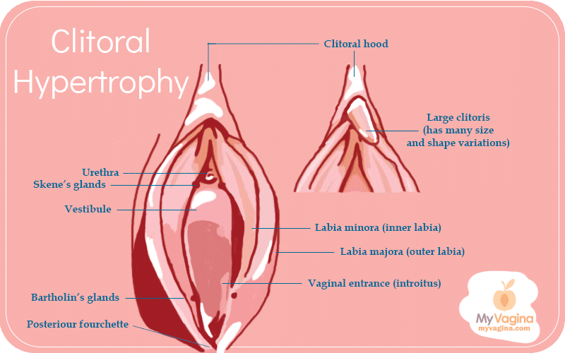 Large Clitoris Clitoral Hypertrophy