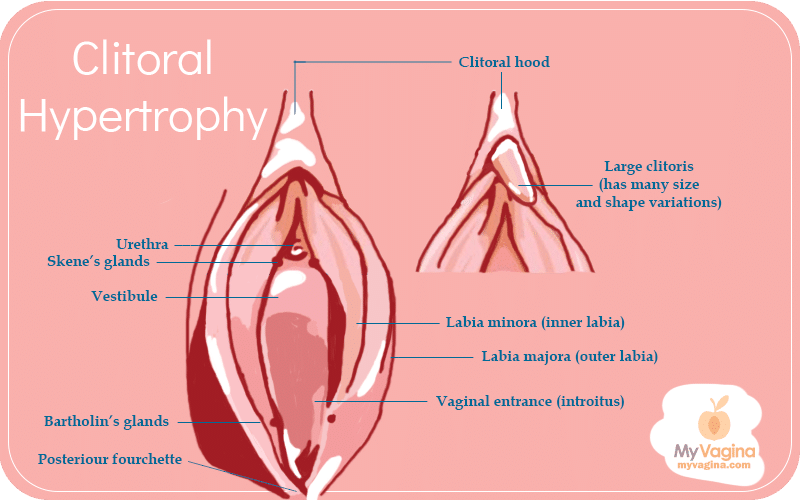 Large Clitoris Clitoral Hypertrophy