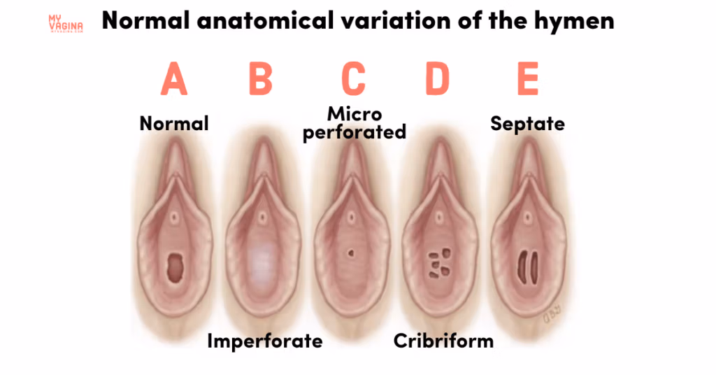 Diagram showing normal variations in the appearance of the hymen